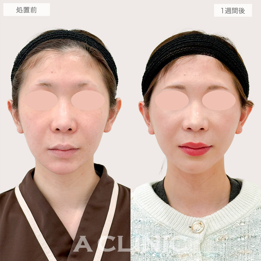 A式美肌たるみ切開で顔の重心が上がり劇的に若返り！処置前と1週間後の症例です(30代女性)
