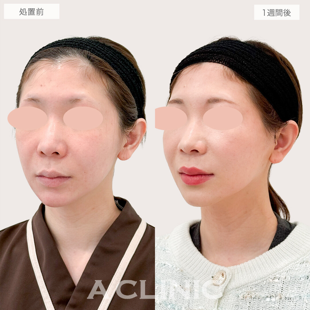A式美肌たるみ切開で顔の重心が上がり劇的に若返り！処置前と1週間後の症例です(30代女性)