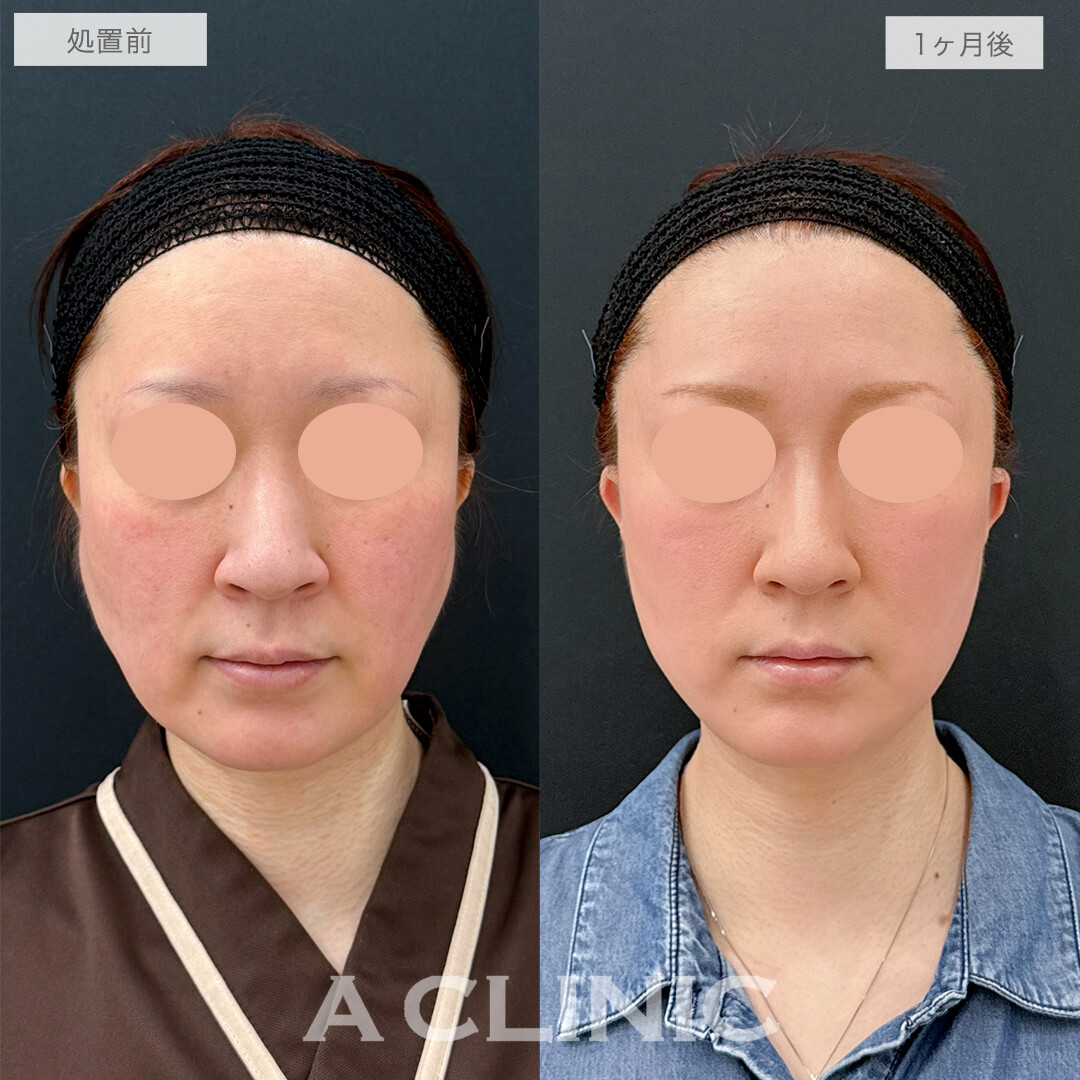 A式美肌たるみ切開で左右差が整い美しい輪郭に！処置前と1ヶ月後の症例です(40代女性)