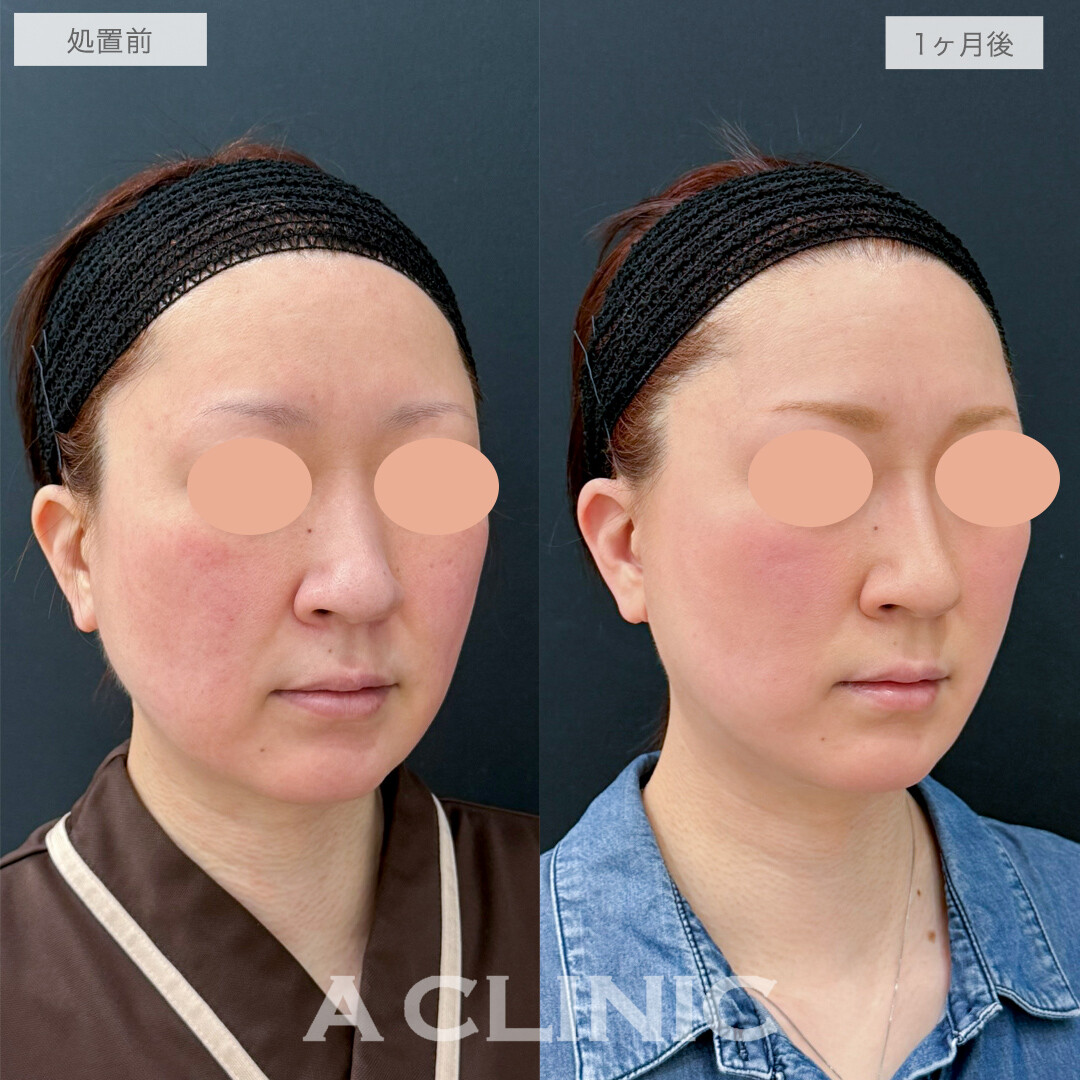 A式美肌たるみ切開で左右差が整い美しい輪郭に！処置前と1ヶ月後の症例です(40代女性)