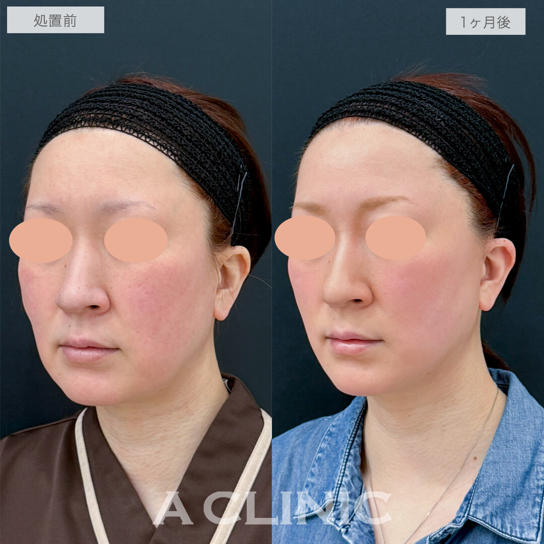 A式美肌たるみ切開で左右差が整い美しい輪郭に！処置前と1ヶ月後の症例です(40代女性)