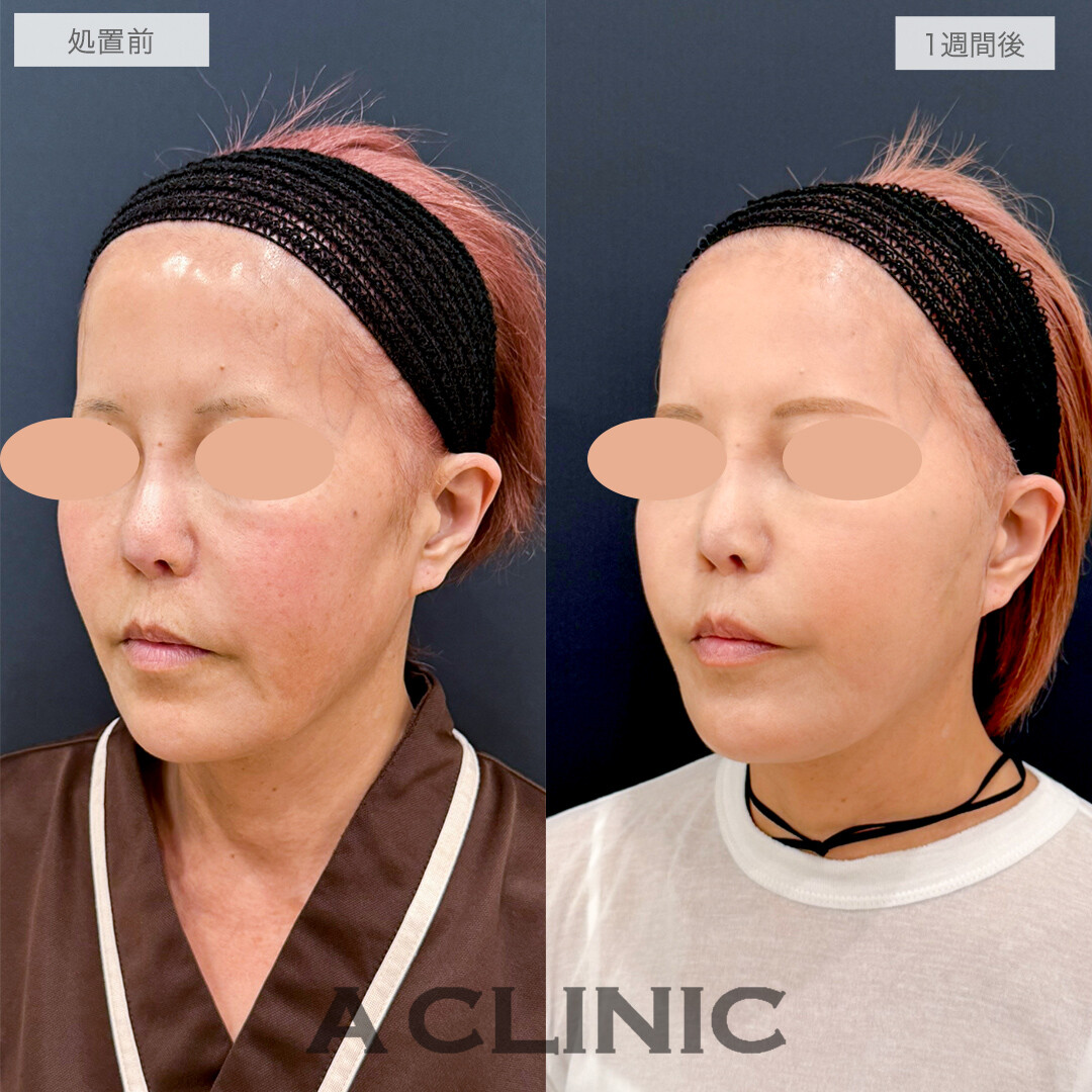 A式美肌たるみ切開と頬へのヒアルロン酸注入でお顔にハリを取り戻して若返り！処置前と1週間後の症例です(60代女性)