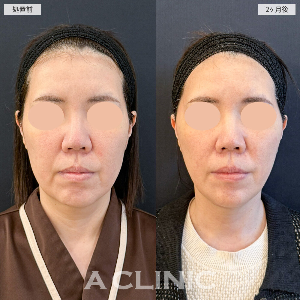 【直後の傷跡あり】A式美肌たるみ切開と1day小顔脂肪吸引を組み合わせたら、たるみが無くなり顔の重心UPしました！こちら処置前と2ヶ月後の症例です。(40代女性)
