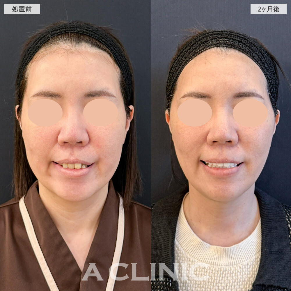 【直後の傷跡あり】A式美肌たるみ切開と1day小顔脂肪吸引を組み合わせたら、たるみが無くなり顔の重心UPしました！こちら処置前と2ヶ月後の症例です。(40代女性)