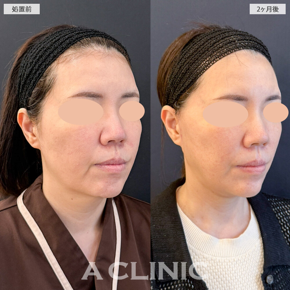 【直後の傷跡あり】A式美肌たるみ切開と1day小顔脂肪吸引を組み合わせたら、たるみが無くなり顔の重心UPしました！こちら処置前と2ヶ月後の症例です。(40代女性)