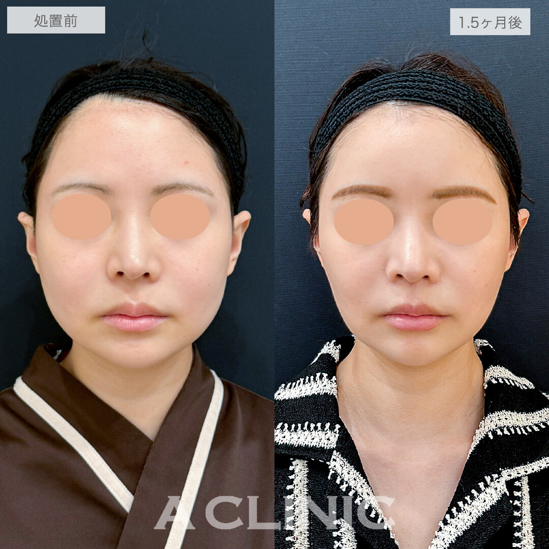 1day小顔脂肪吸引と小顔エラボトックスで劇的な小顔に！処置前と1.5ヶ月後の症例です（30代女性）