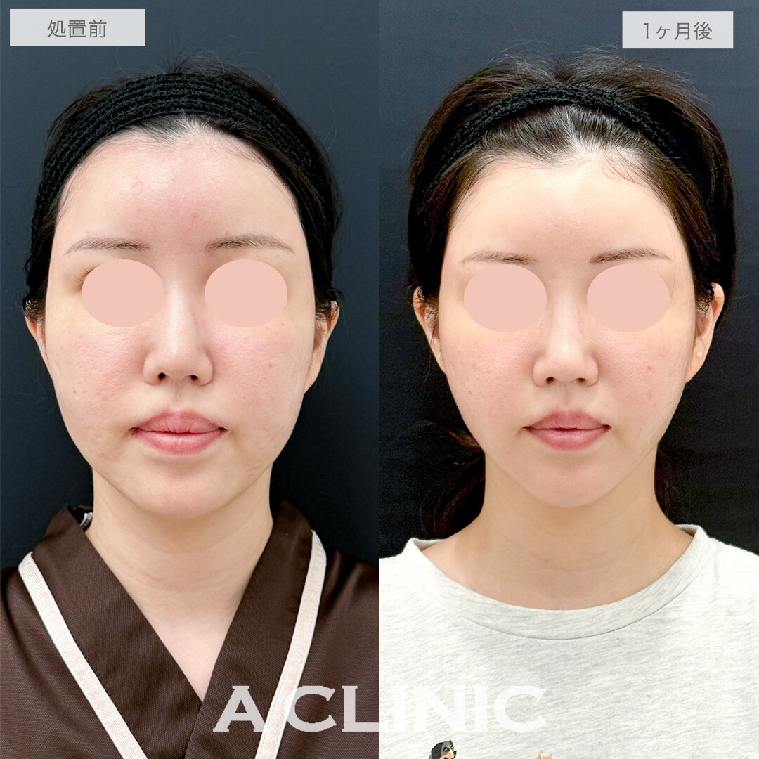 1day小顔脂肪吸引で気になるほうれい線も口横のたるみもスッキリ！処置前と1ヶ月後の症例です(30代女性)