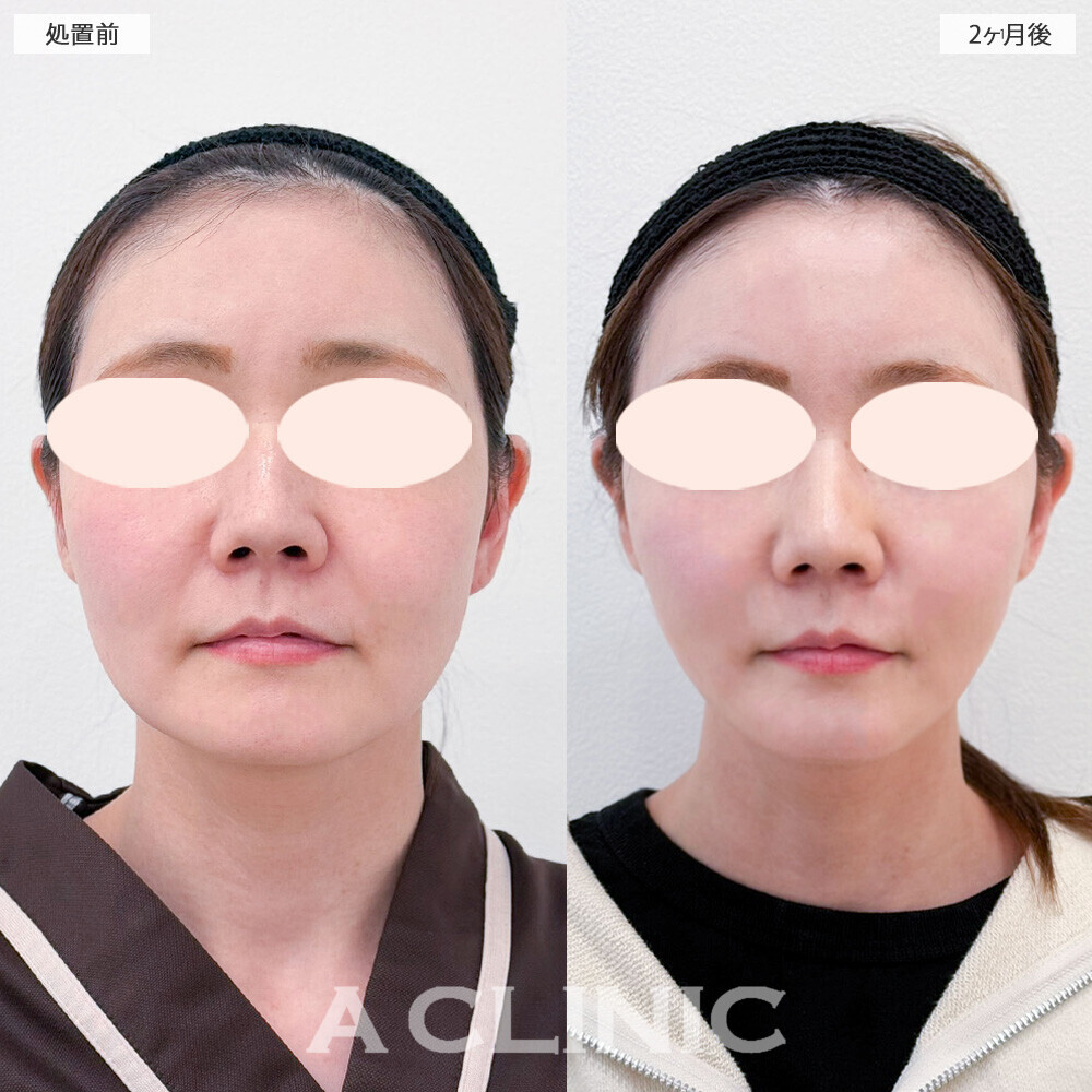 1day小顔脂肪吸引で顔の丸さ解消！こちら処置前と2ヶ月後の症例です。(40代女性)