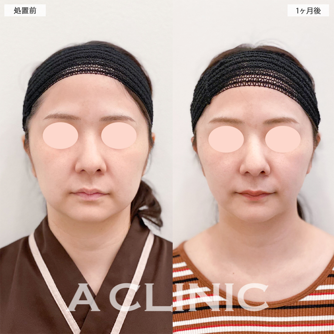 1day小顔脂肪吸引で余分な脂肪が無くなり綺麗なフェイスラインが出ました！こちら処置前と1ヶ月後の症例です(20代女性)