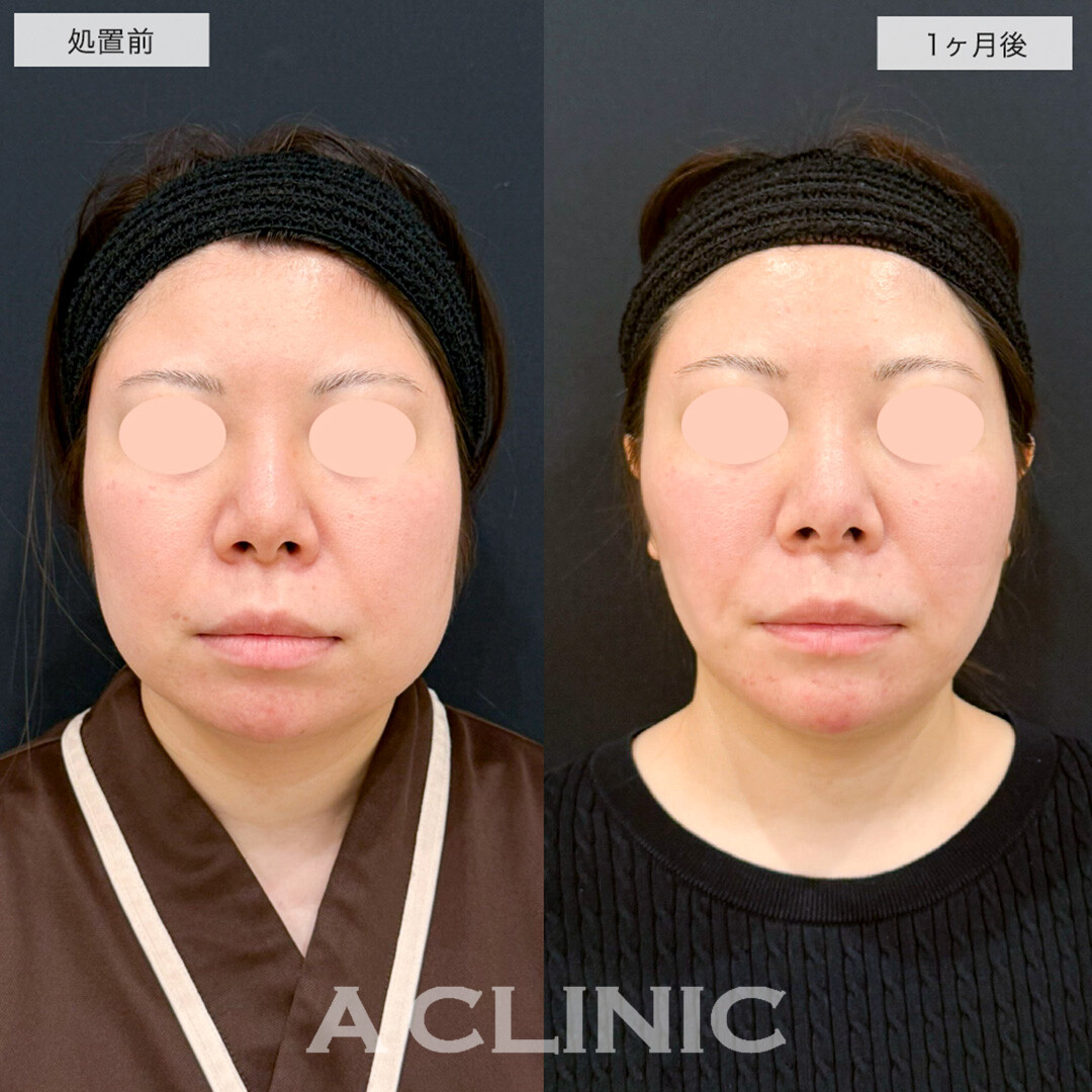 1day小顔脂肪吸引とあごへのヒアルロン酸注入で丸顔が改善し理想の卵型輪郭へ!こちら処置前と1ヶ月後の症例です(30代女性)