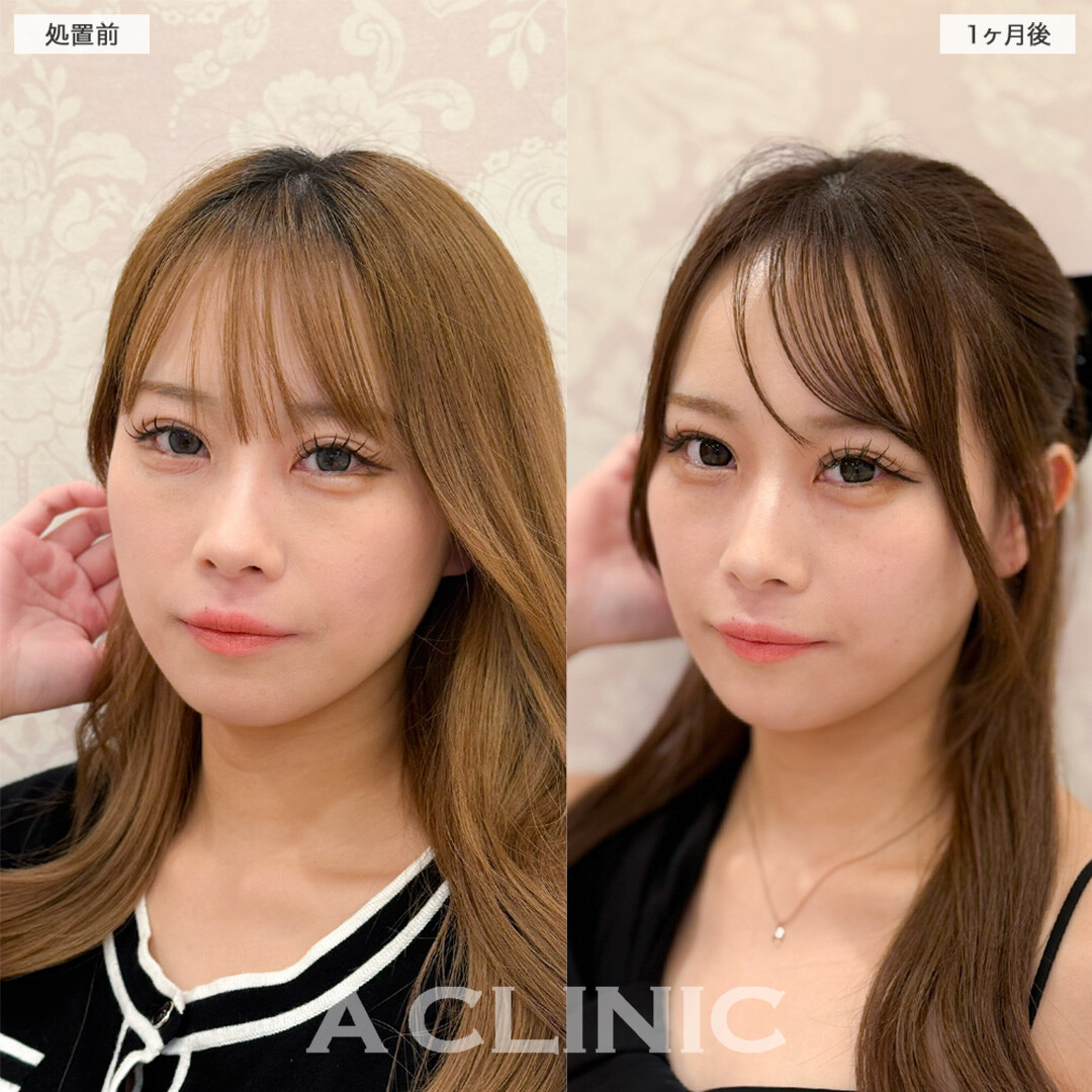 1day小顔脂肪吸引とあごへのヒアルロン酸注入を組み合わせて余白減らして小顔アップデート！こちら処置前と直後の症例です(20代女性)
