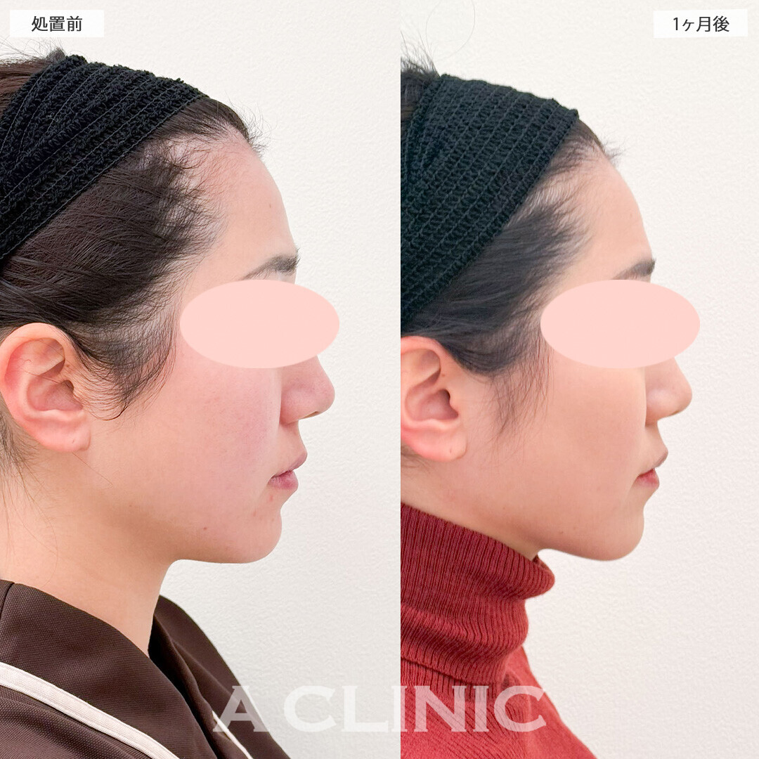 1day小顔脂肪吸引で横顔美人になりました！処置前から2ヶ月後の症例です(20代女性)