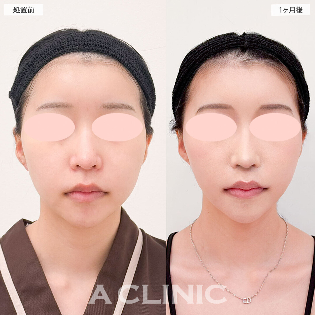 1day小顔脂肪吸引でVフェイスに近づき垢抜けました！処置前と1ヶ月後の症例です(10代女性)