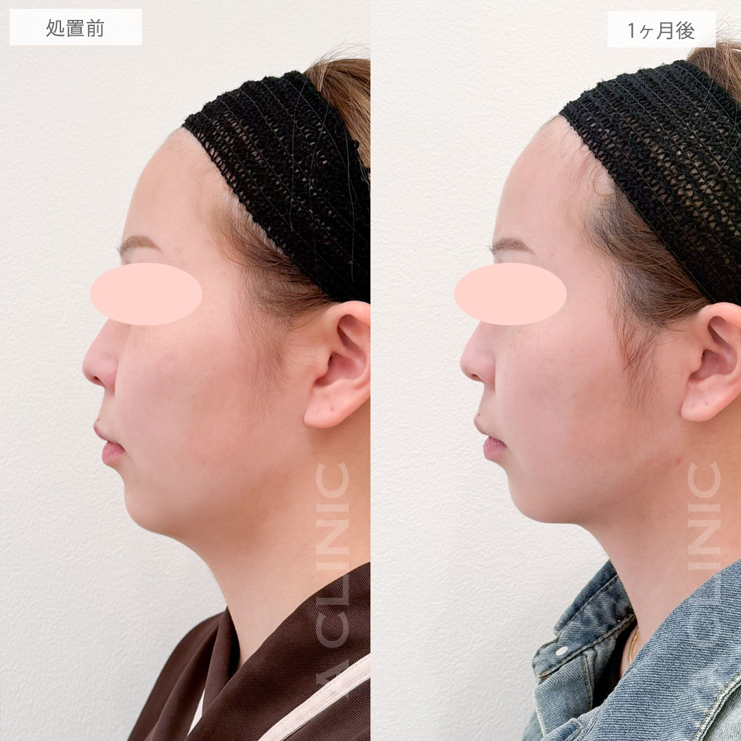 1day小顔脂肪吸引であご下の脂肪がなくなりスッキリした横顔に！処置前から2ヶ月後の症例です(20代女性)