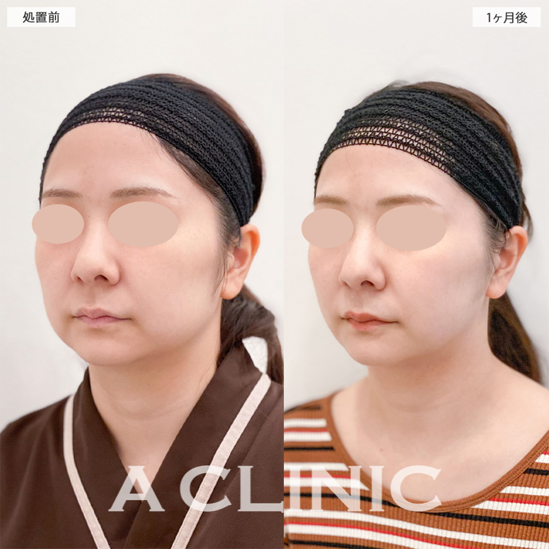 1day小顔脂肪吸引で余分な脂肪が無くなり綺麗なフェイスラインが出ました！こちら処置前と1ヶ月後の症例です(20代女性)