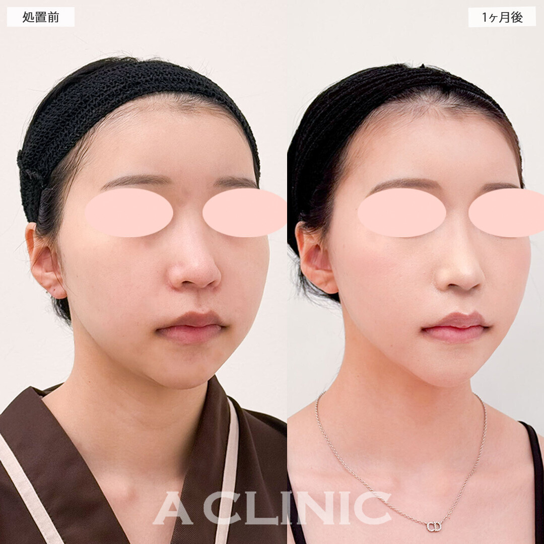 1day小顔脂肪吸引でVフェイスに近づき垢抜けました！処置前と1ヶ月後の症例です(10代女性)