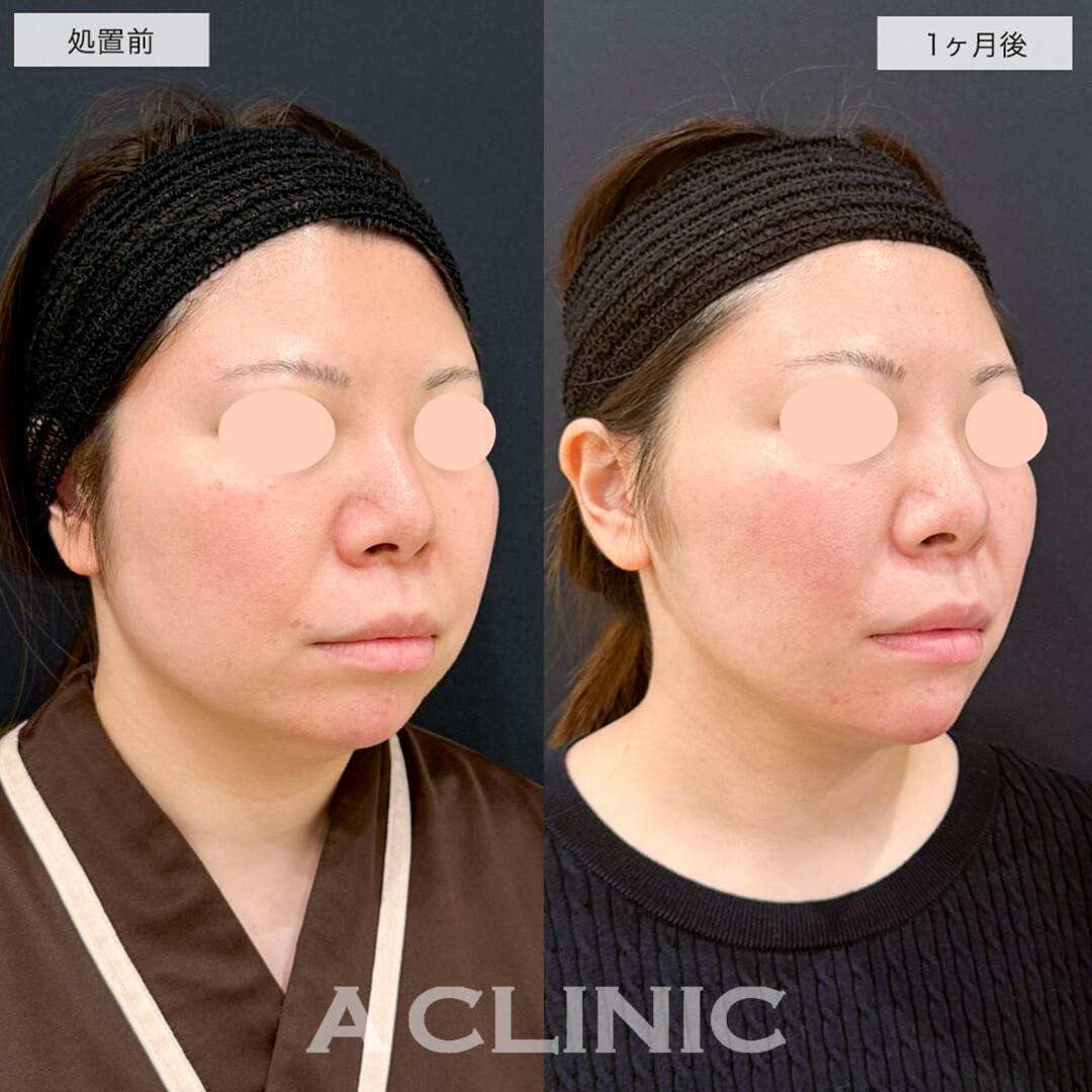 1day小顔脂肪吸引とあごへのヒアルロン酸注入で丸顔が改善し理想の卵型輪郭へ!こちら処置前と1ヶ月後の症例です(30代女性)