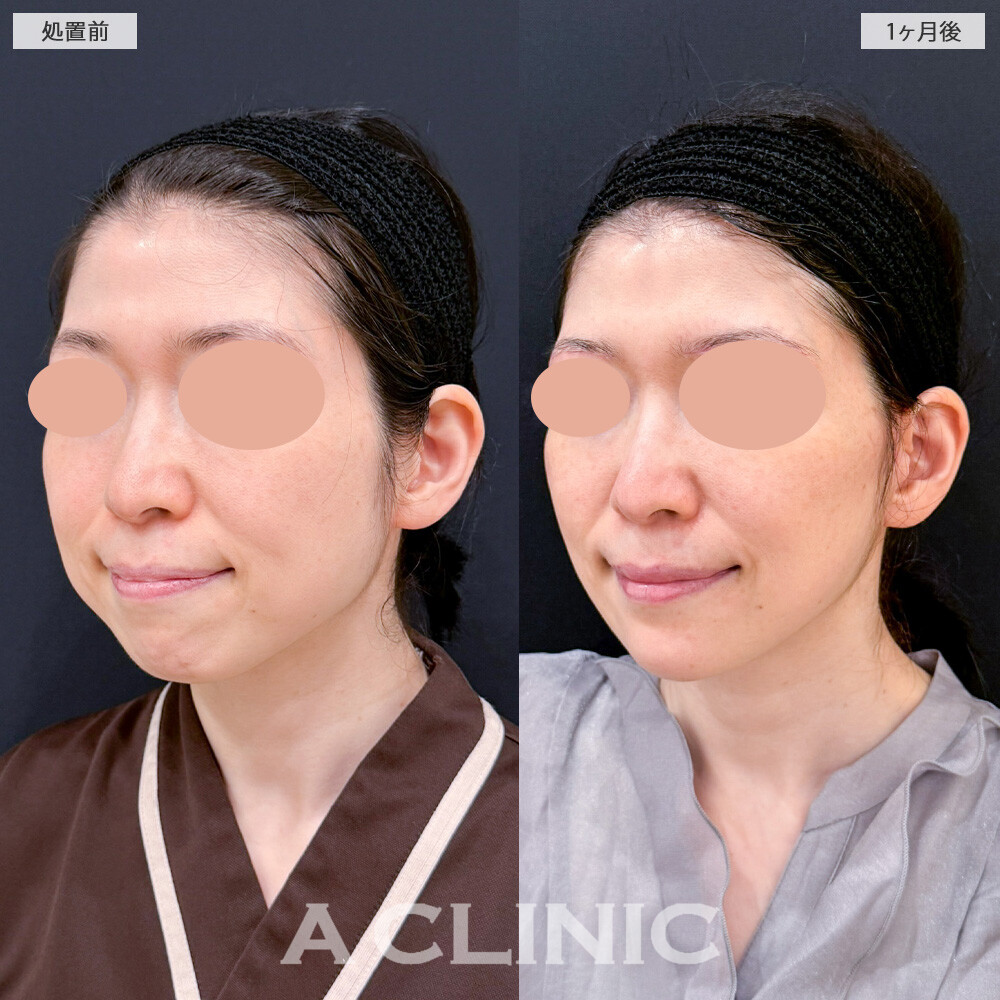 1day小顔脂肪吸引とA式美肌たるみ切開でフェイスラインのボリュームが無くなってスッキリ小顔に！こちら処置前と1ヶ月後の症例です(40代女性)