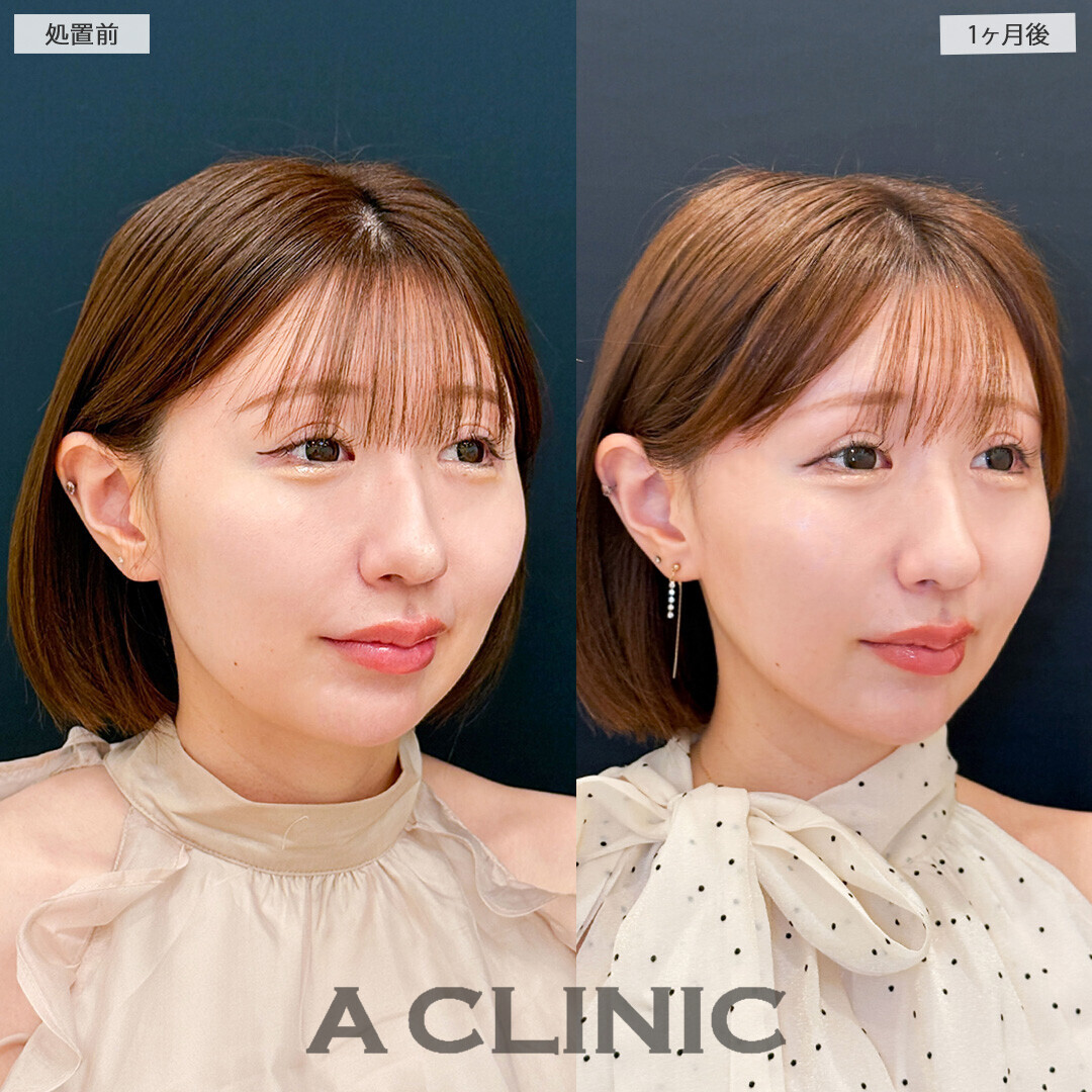 1day小顔脂肪吸引で脂肪もたるみも無くなり更に若返りました！処置前と1ヶ月後の症例です(30代女性)