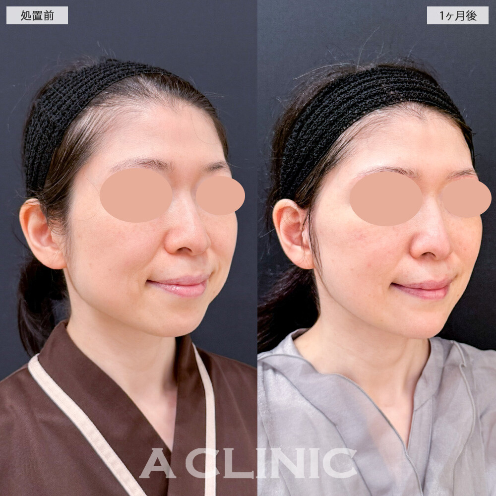 1day小顔脂肪吸引とA式美肌たるみ切開でフェイスラインのボリュームが無くなってスッキリ小顔に！こちら処置前と1ヶ月後の症例です(40代女性)