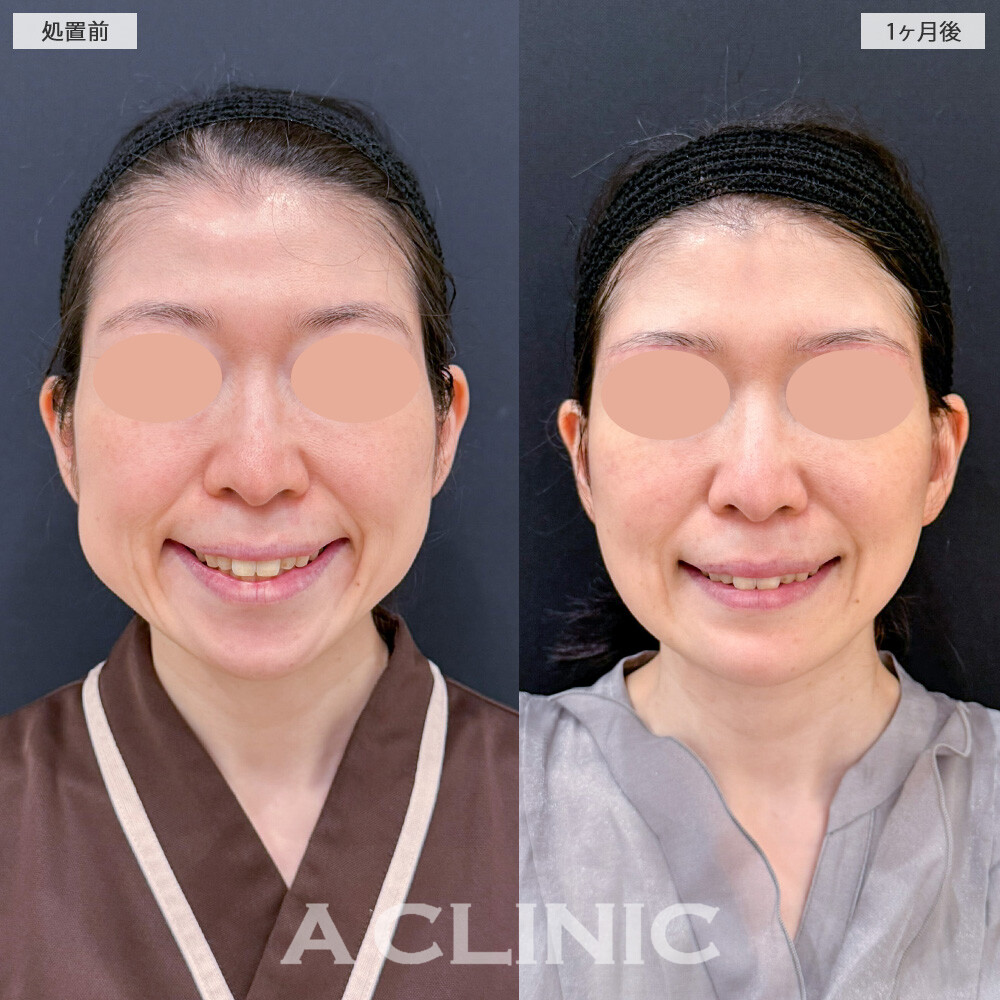 1day小顔脂肪吸引とA式美肌たるみ切開でフェイスラインのボリュームが無くなってスッキリ小顔に！こちら処置前と1ヶ月後の症例です(40代女性)