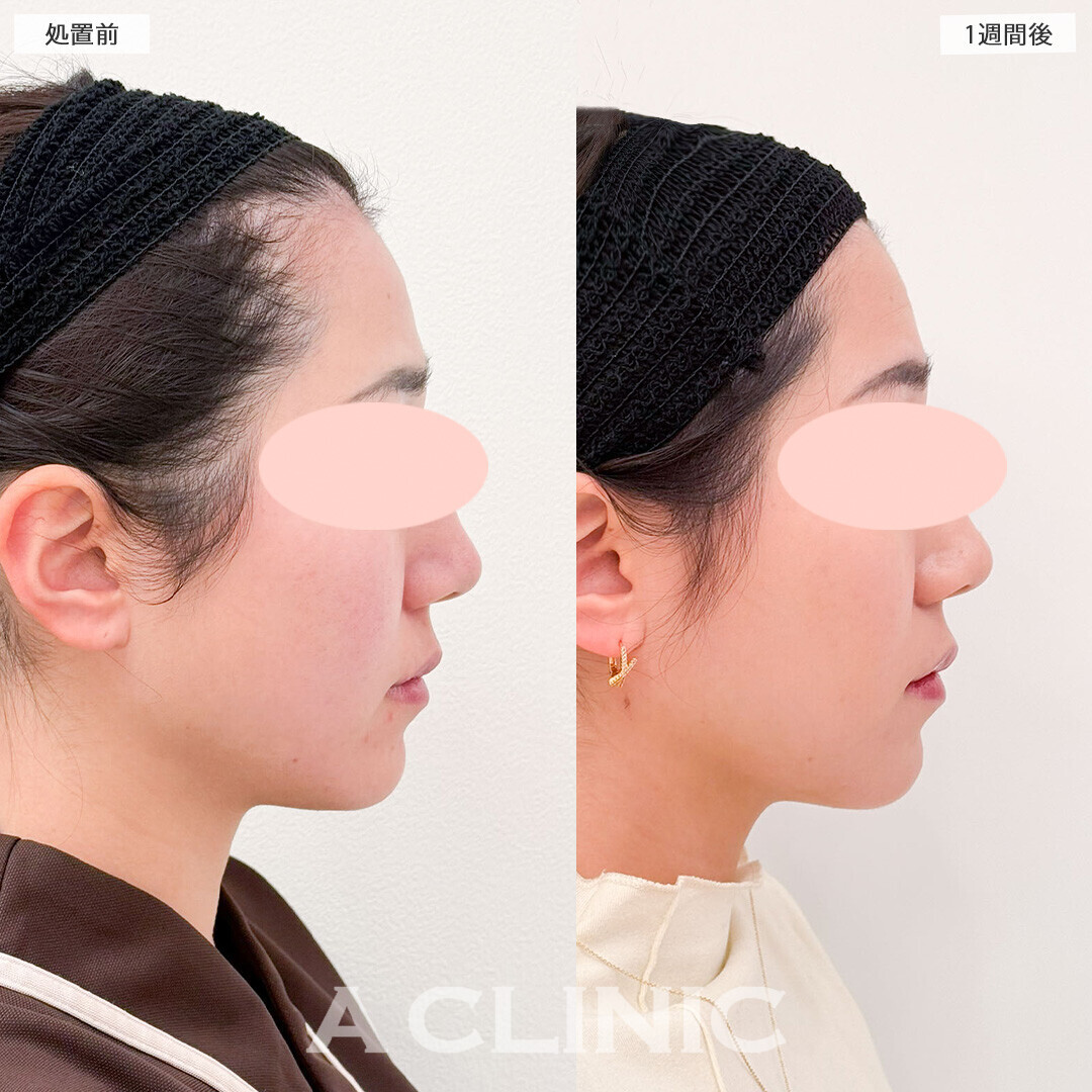 1day小顔脂肪吸引で横顔美人になりました！処置前から2ヶ月後の症例です(20代女性)