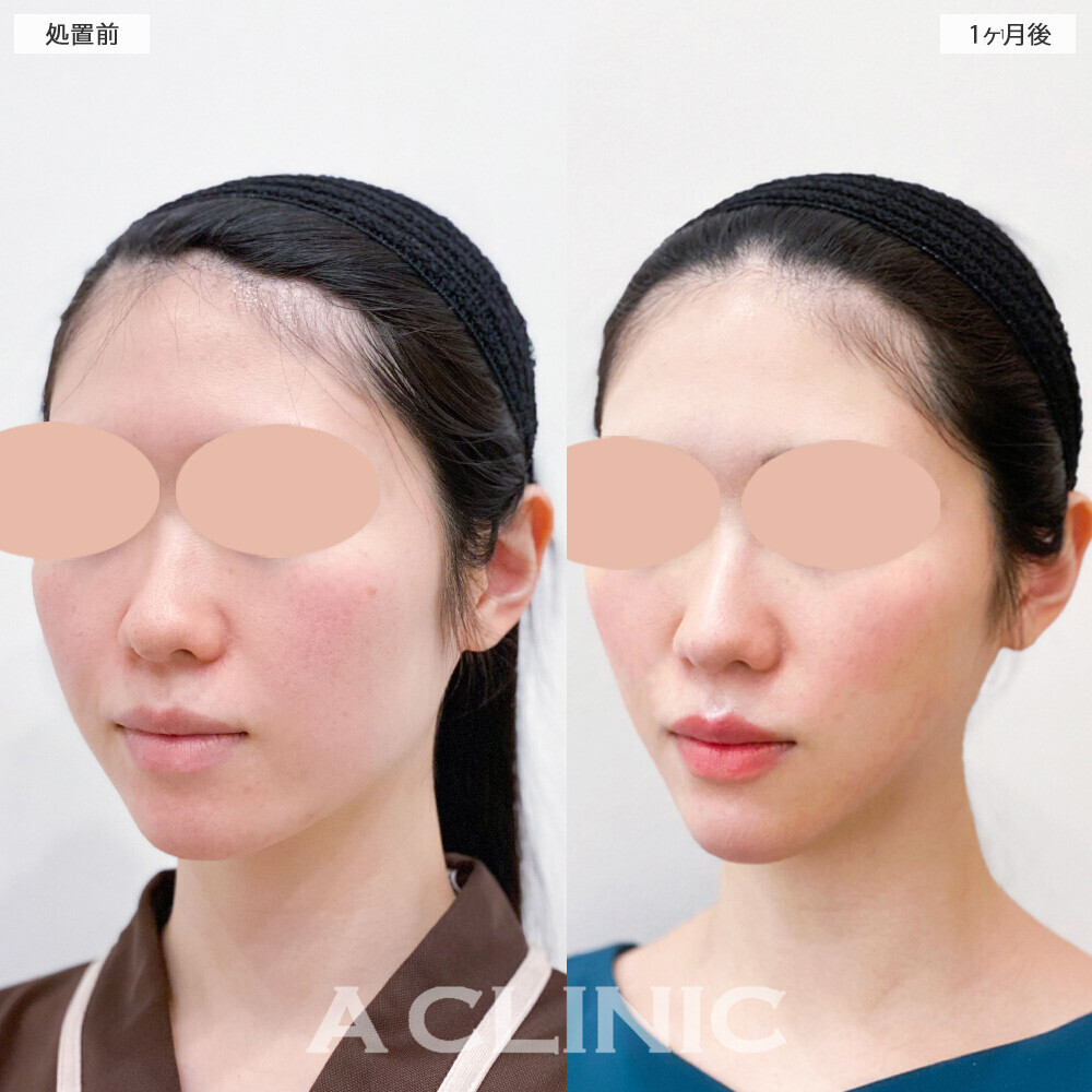 1day小顔脂肪吸引で頬のふくらみ解消！こちら処置前から1ヶ月後の症例です。(20代女性)