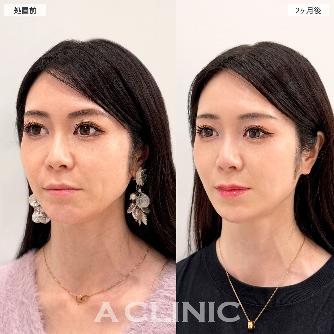 1day小顔脂肪吸引と小顔エラボトックスで輪郭が整いさらに小顔になりました！処置前と2ヶ月後の症例です(30代女性)