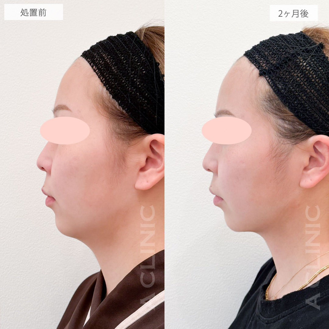 1day小顔脂肪吸引であご下の脂肪がなくなりスッキリした横顔に！処置前から2ヶ月後の症例です(20代女性)