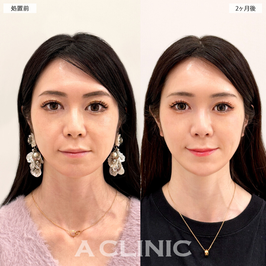 1day小顔脂肪吸引と小顔エラボトックスで輪郭が整いさらに小顔になりました！処置前と2ヶ月後の症例です(30代女性)