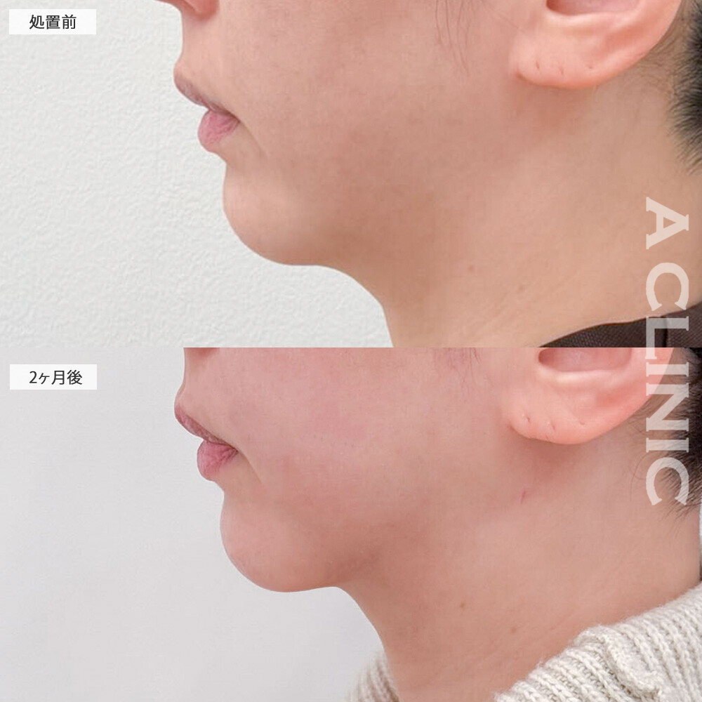 1day小顔脂肪吸引でフェイスラインがくっきり出てあご下のもたつきも解消！こちら処置前と2ヶ月後の症例です。(30代女性)