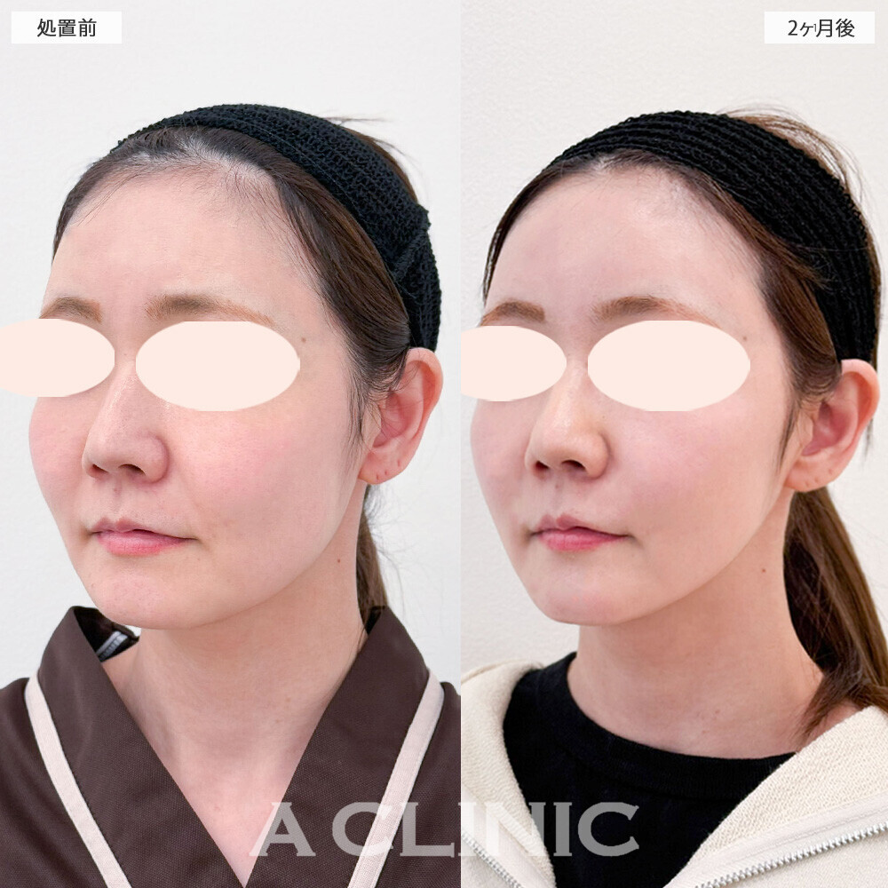 1day小顔脂肪吸引で顔の丸さ解消！こちら処置前と2ヶ月後の症例です。(40代女性)