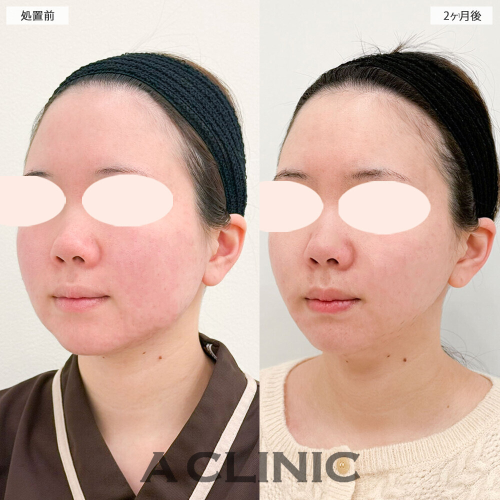 1day小顔脂肪吸引で卵型に整いました！こちら処置前と2ヶ月後の症例です。(20代女性)