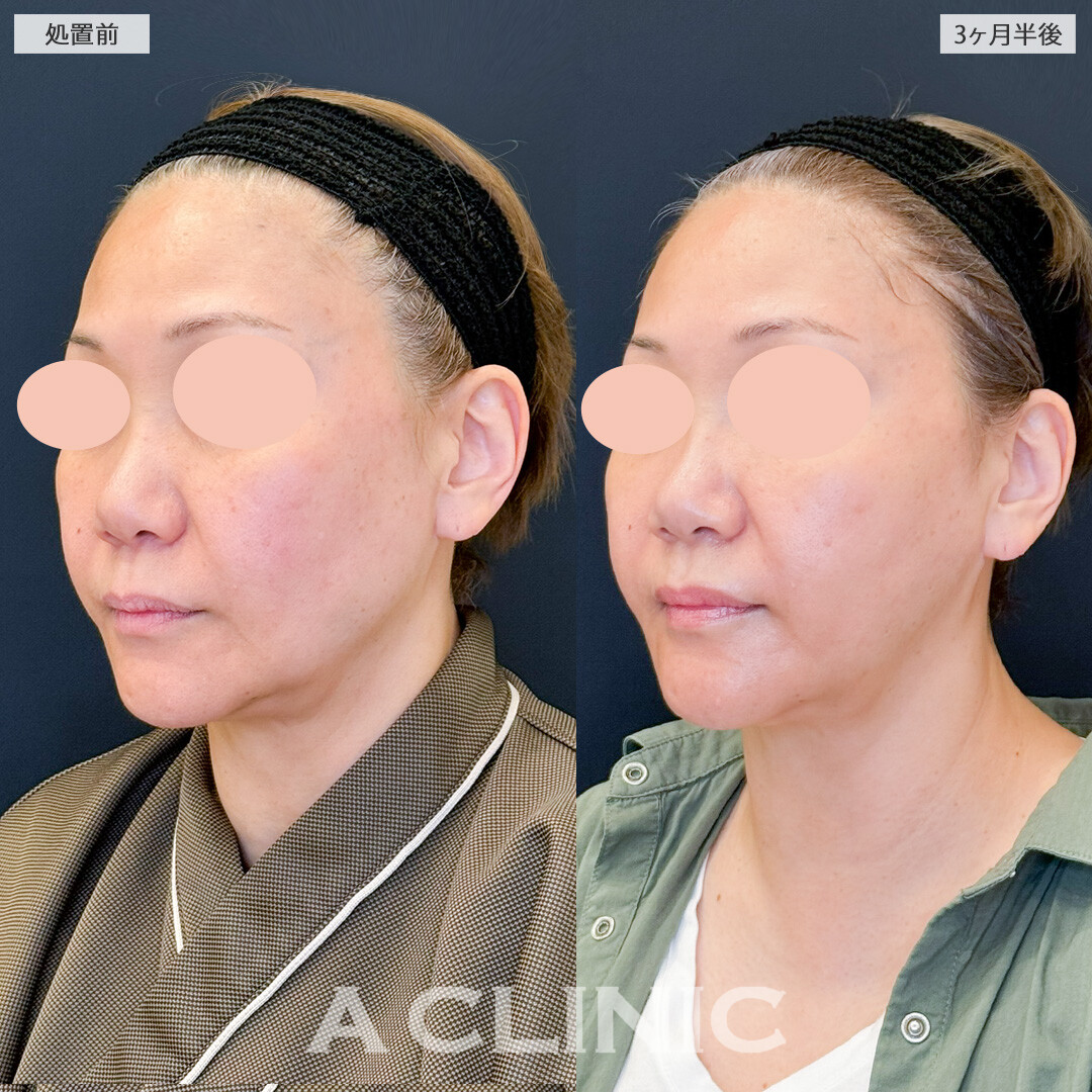 1day小顔脂肪吸引と小顔エラボトックスでフェイスラインのたるみとおさらば！処置前と3ヶ月半後の症例です(50代女性)