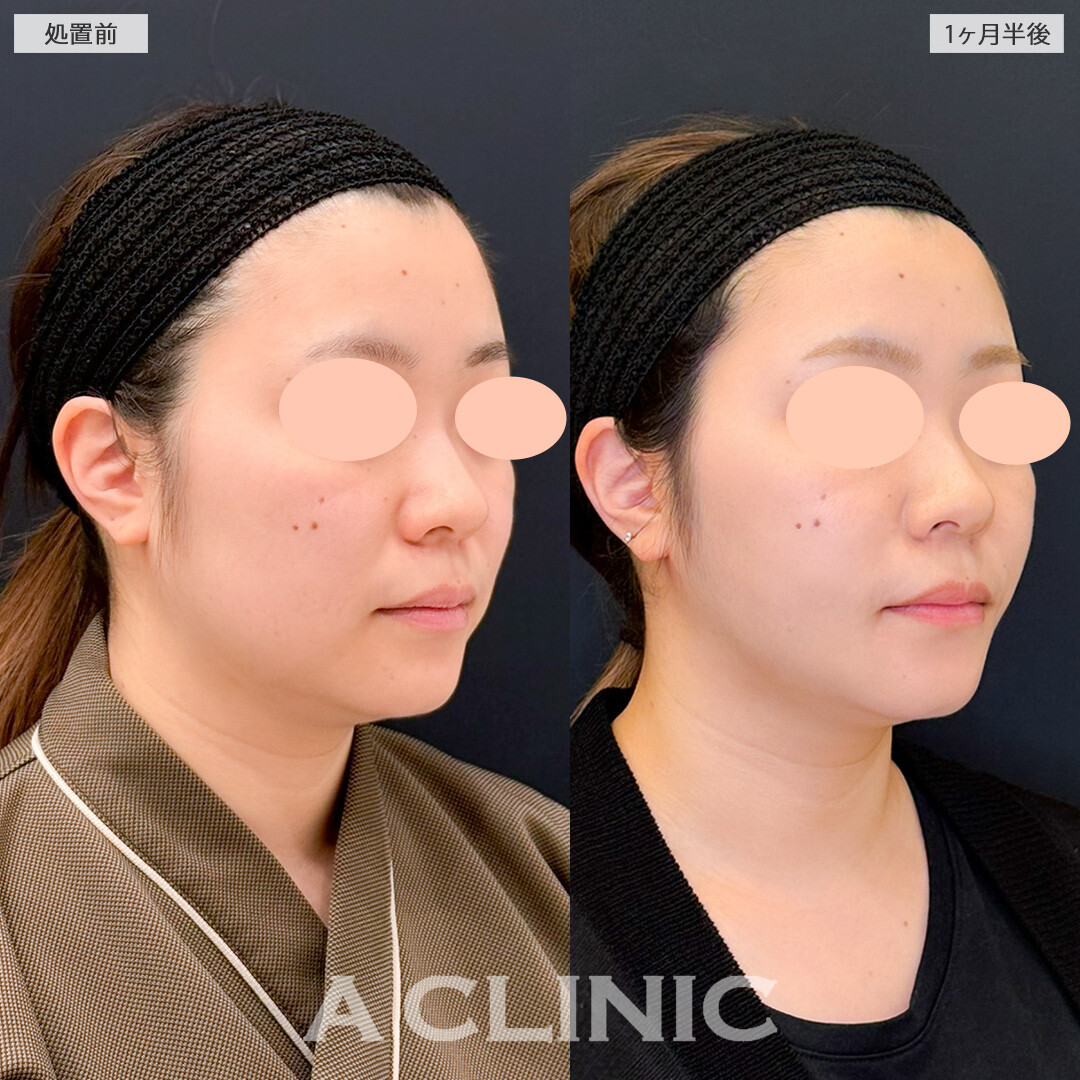 1day小顔脂肪吸引と小顔エラボトックスで輪郭を変えるだけでもお顔の印象が変わります！処置前と1ヶ月半後の症例です(20代女性)