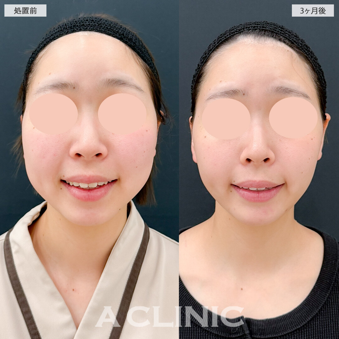 1day小顔脂肪吸引とバッカルファット除去術で下膨れがスッキリ！処置前と3ヶ月後の症例です(20代女性)