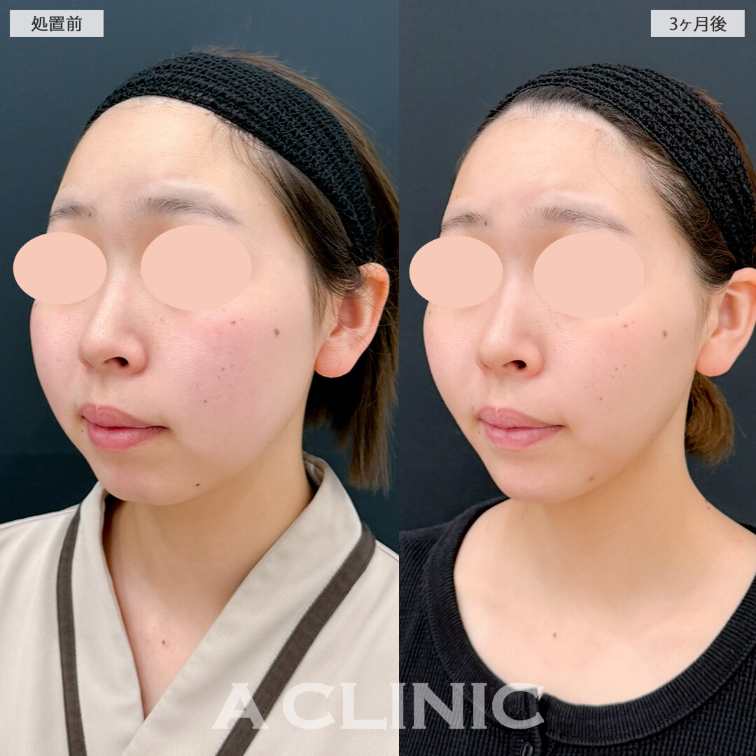 1day小顔脂肪吸引とバッカルファット除去術で下膨れがスッキリ！処置前と3ヶ月後の症例です(20代女性)