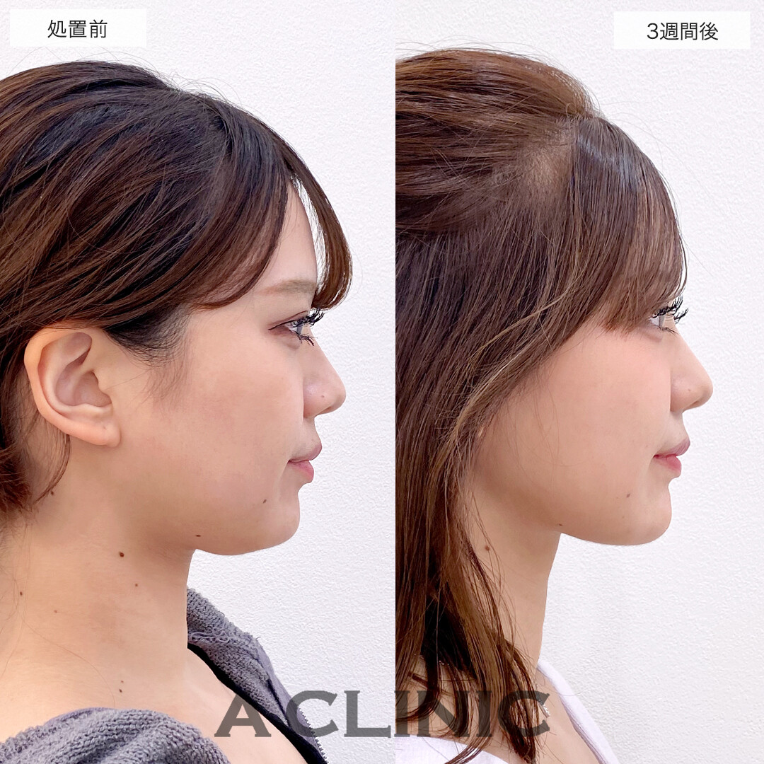 1day小顔脂肪吸引、ボトックス注射、ヒアルロン酸でビジュ爆上がり！処置前と3週間後の症例です(20代女性)