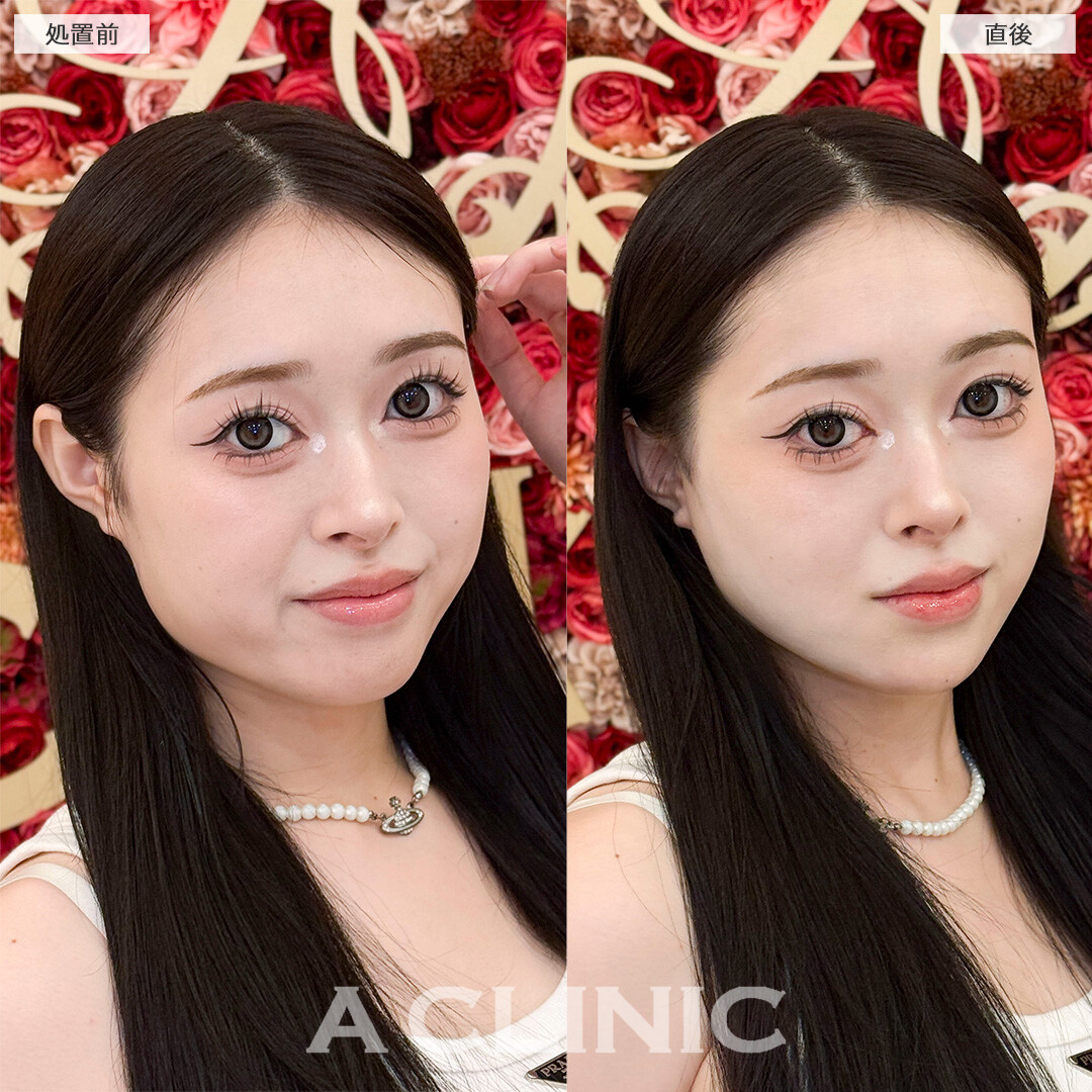 1day小顔脂肪吸引なら直後からVフェイスが叶う！処置前と直後の症例です(20代女性)