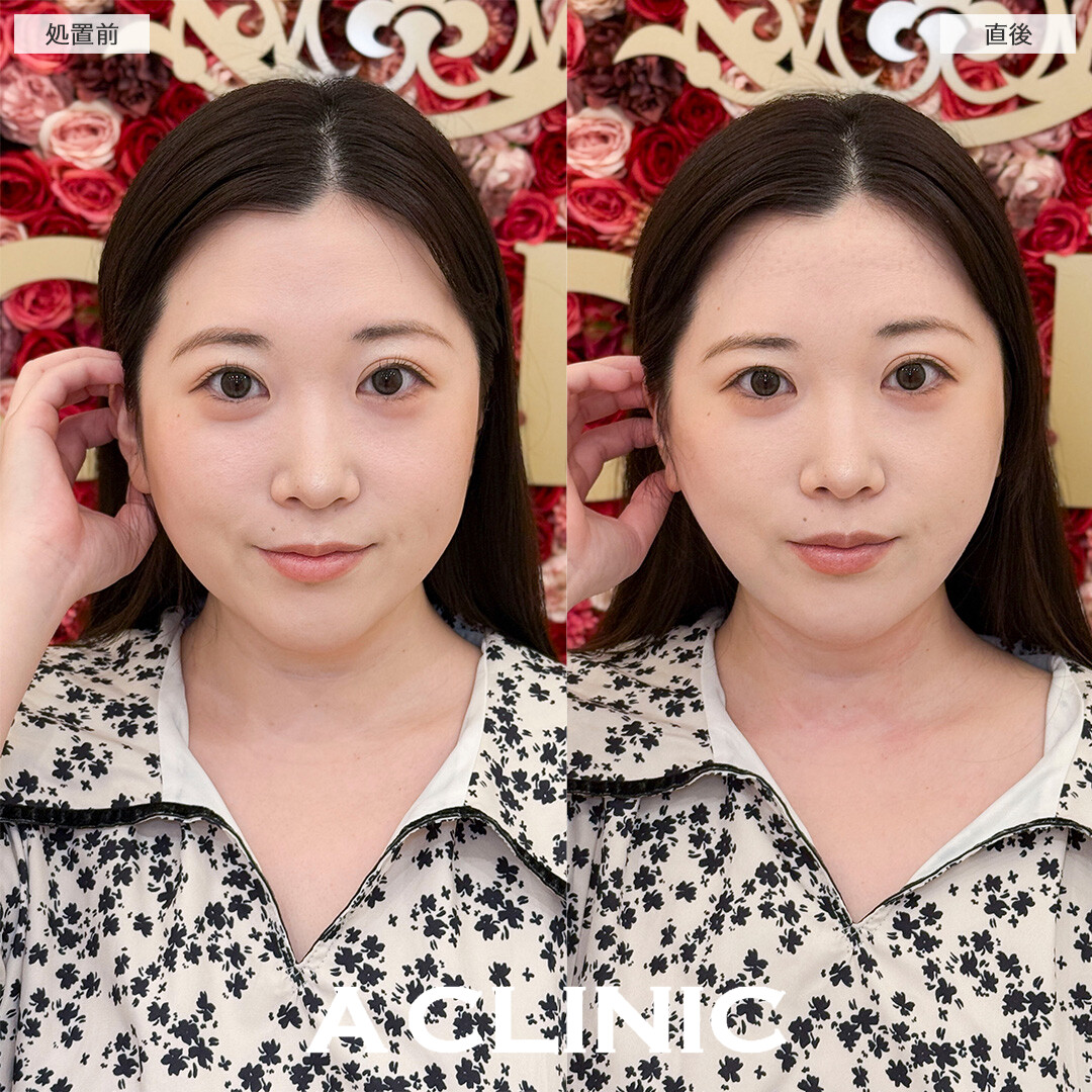 1day小顔脂肪吸引なら直後から腫れ最小限でお買い物も行けちゃいます！処置前と直後の症例です(30代女性)