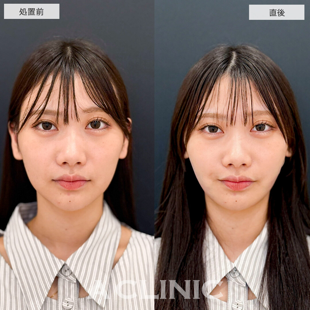 1day小顔脂肪吸引で直後から圧倒的に可愛い小顔に!こちら処置前と直後の症例です(20代女性)