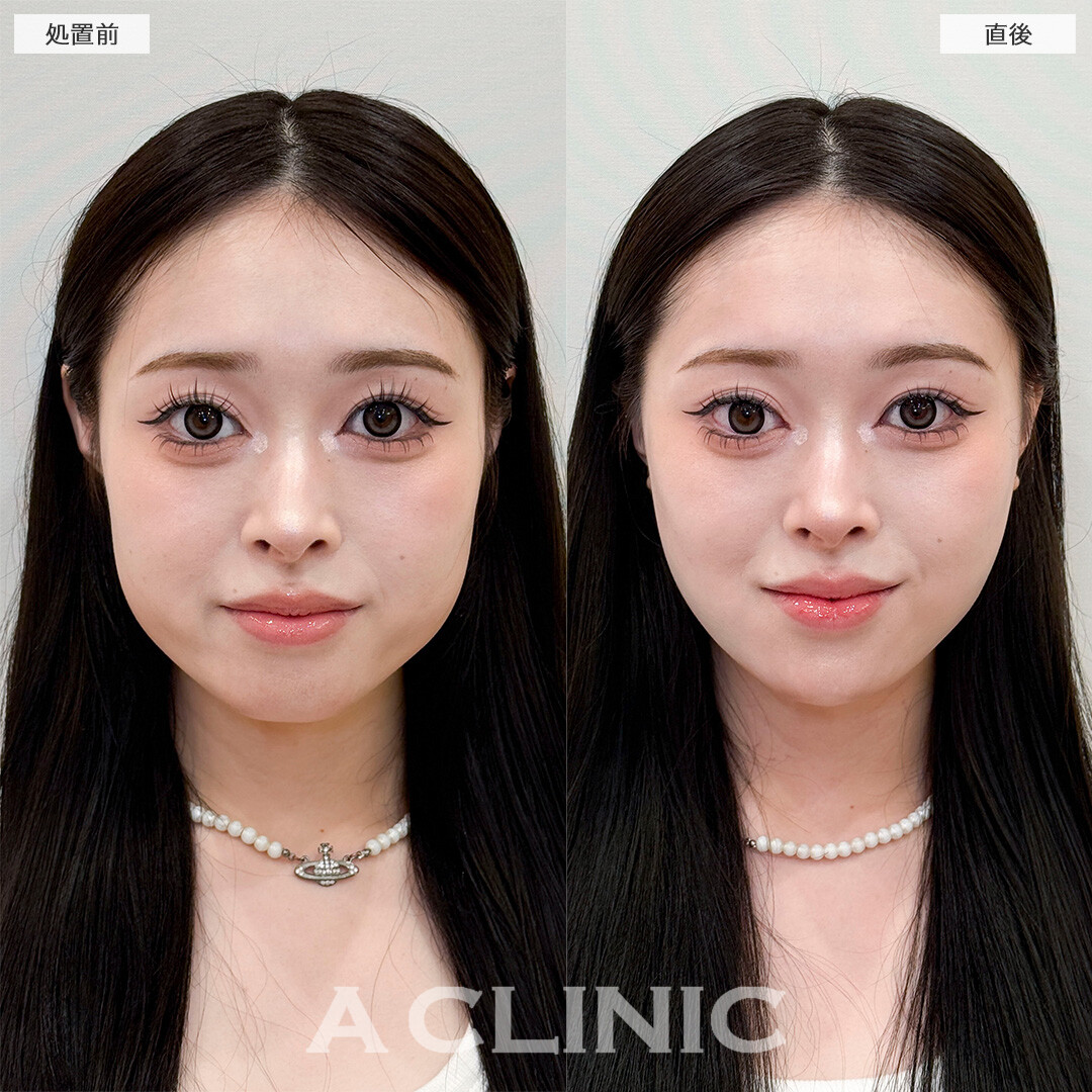 1day小顔脂肪吸引なら直後からVフェイスが叶う！処置前と直後の症例です(20代女性)