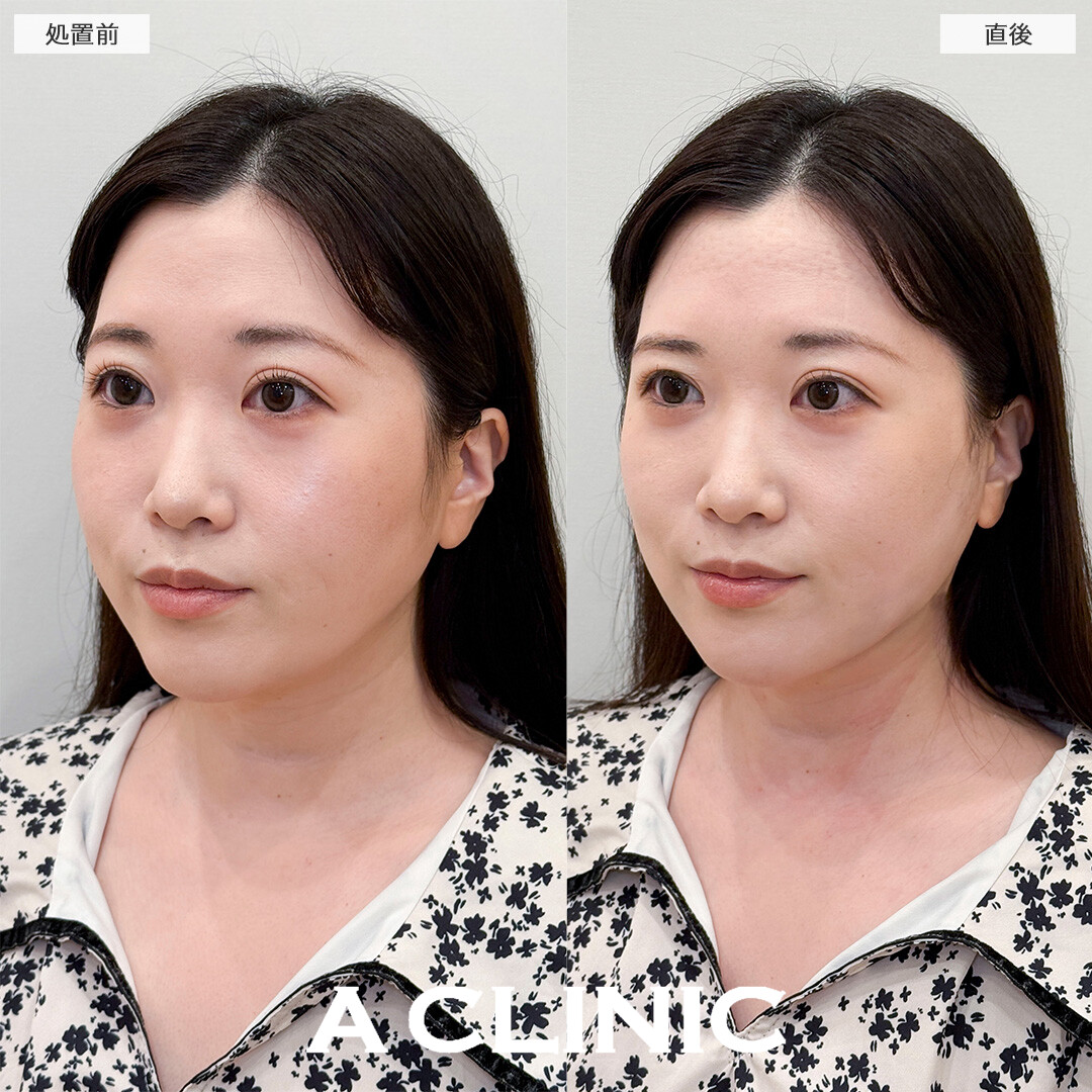 1day小顔脂肪吸引なら直後から腫れ最小限でお買い物も行けちゃいます！処置前と直後の症例です(30代女性)