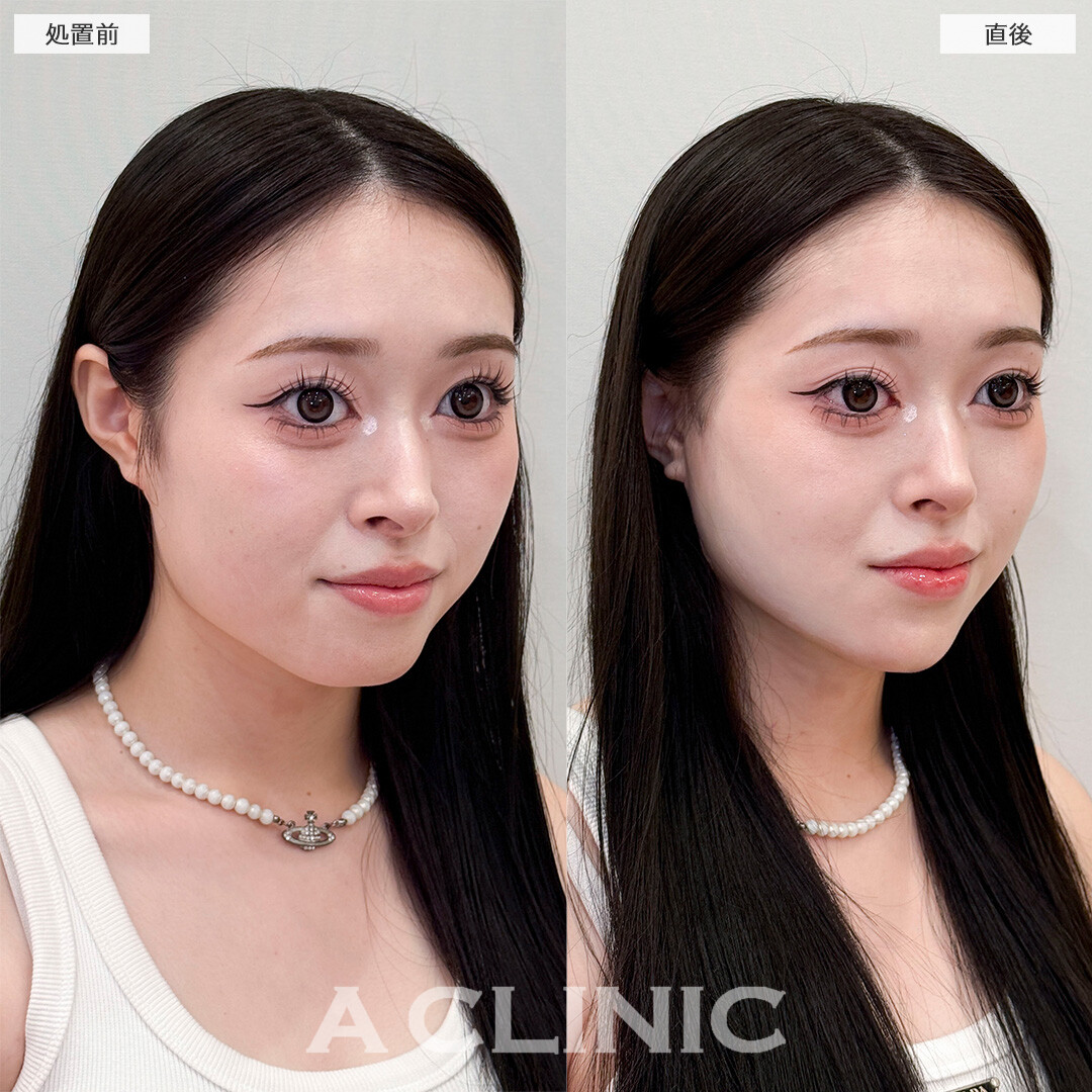 1day小顔脂肪吸引なら直後からVフェイスが叶う！処置前と直後の症例です(20代女性)