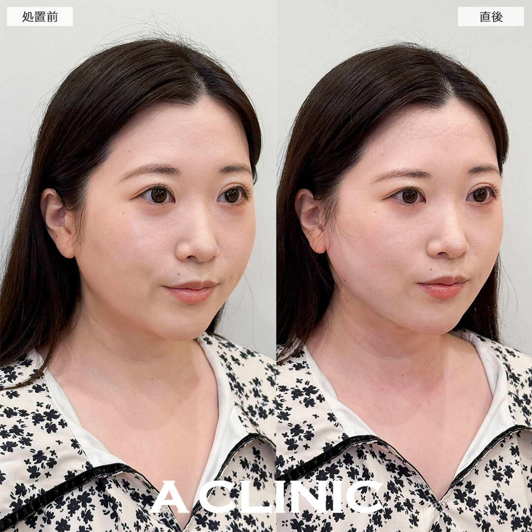 1day小顔脂肪吸引なら直後から腫れ最小限でお買い物も行けちゃいます！処置前と直後の症例です(30代女性)