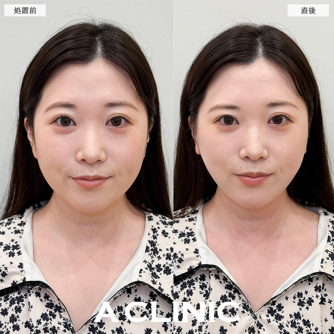 1day小顔脂肪吸引なら直後から腫れ最小限でお買い物も行けちゃいます！処置前と直後の症例です(30代女性)