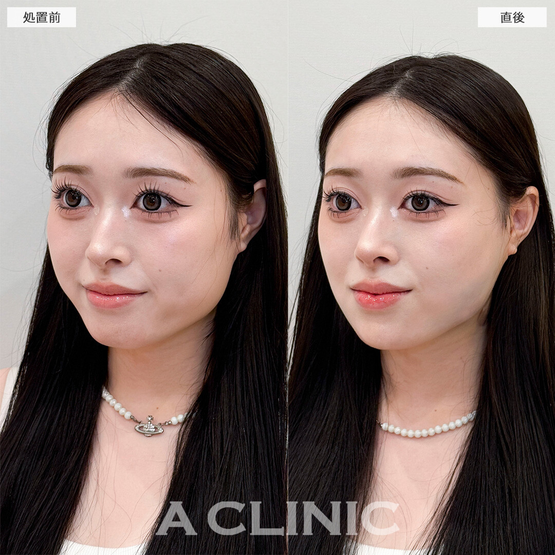 1day小顔脂肪吸引なら直後からVフェイスが叶う！処置前と直後の症例です(20代女性)