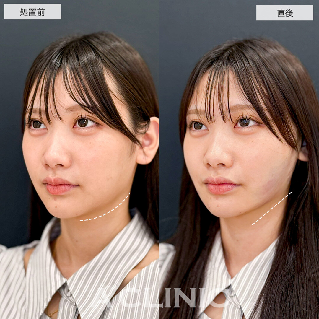 1day小顔脂肪吸引で直後から圧倒的に可愛い小顔に!こちら処置前と直後の症例です(20代女性)
