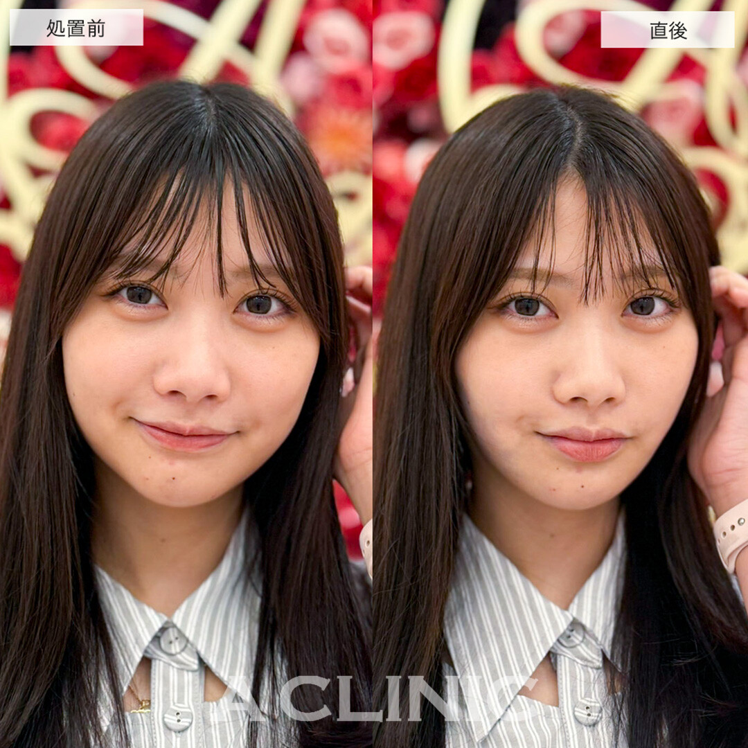 1day小顔脂肪吸引で直後から圧倒的に可愛い小顔に!こちら処置前と直後の症例です(20代女性)