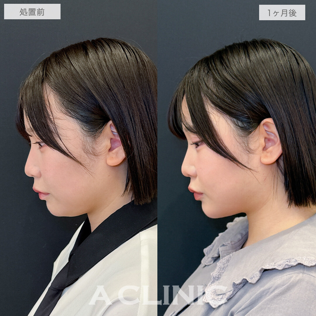 1day小顔脂肪吸引と小顔エラボトックスとあごへのヒアルロン酸注入とボトックス注射(しわ)でどこから見られても怖くないシャープな輪郭に！処置前と1ヶ月後の症例です(20代女性)